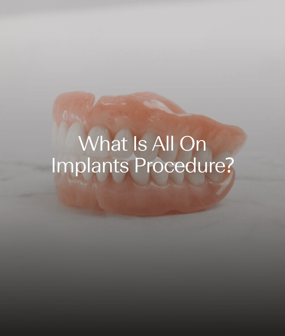 What Is All On Implants™ Procedure?